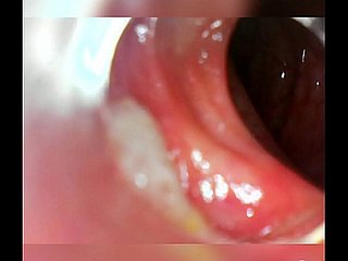 Endoscope 100cm bottomless gulf anal intercalate