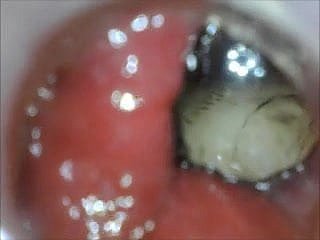 anal endoscope aggravation personate distance from inner